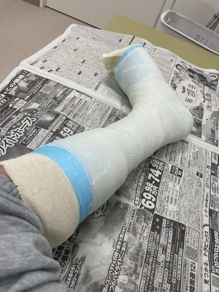 距骨頸部骨折で左足をギプス固定した状態