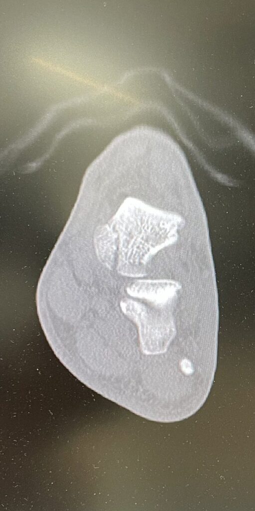 距骨頸部骨折のCT断面画像。骨片が複数に分かれているのが分かる