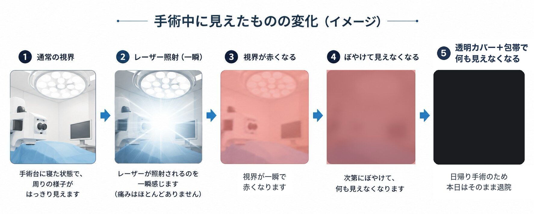 手術中に見えたものの変化：通常の視界からレーザー照射、一瞬で赤くなる視界を経て、透明カバーと包帯で見えなくなるまでの5段階