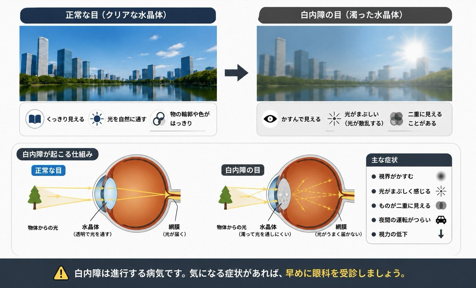 正常な目と白内障の目の見え方比較・水晶体の仕組み・主な症状をまとめた図解